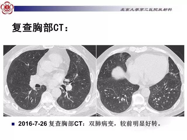 【病例】特发性间质性肺炎2例CT影像表现