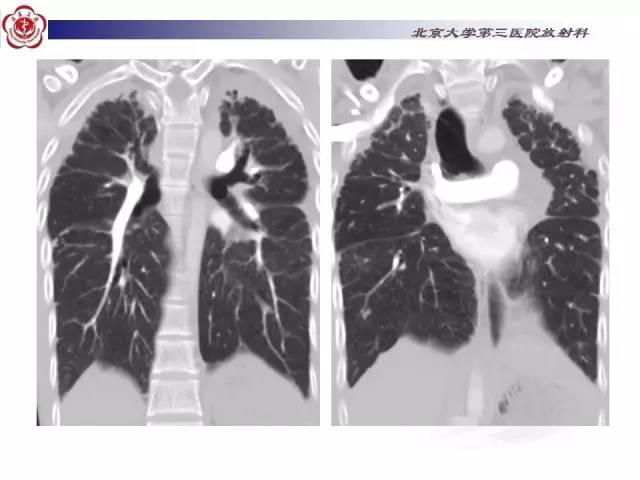【病例】特发性间质性肺炎2例CT影像表现