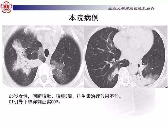 【病例】特发性间质性肺炎2例CT影像表现