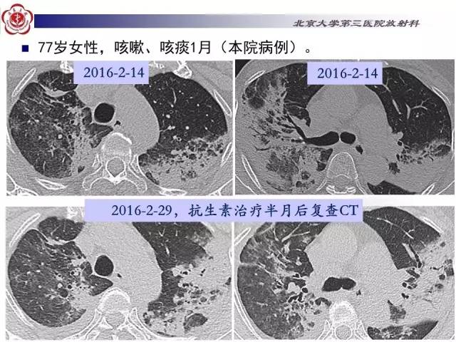 【病例】特发性间质性肺炎2例CT影像表现