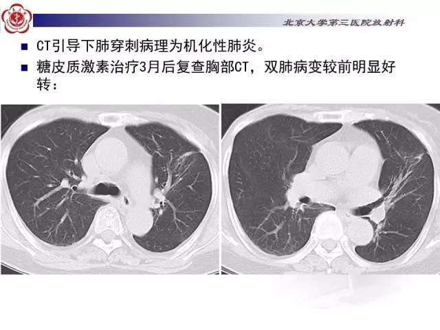 【病例】特发性间质性肺炎2例CT影像表现