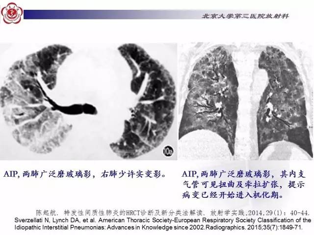 【病例】特发性间质性肺炎2例CT影像表现