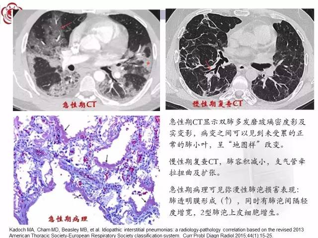 【病例】特发性间质性肺炎2例CT影像表现
