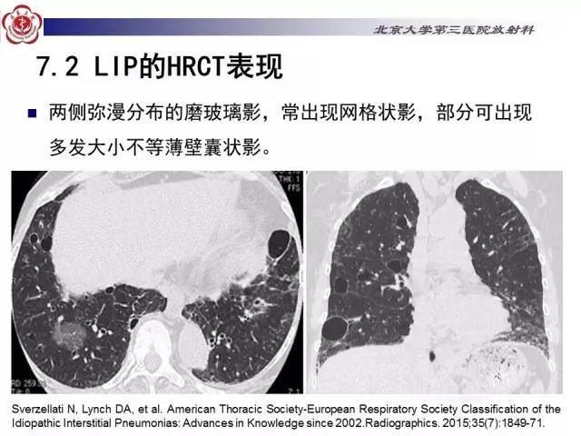 【病例】特发性间质性肺炎2例CT影像表现
