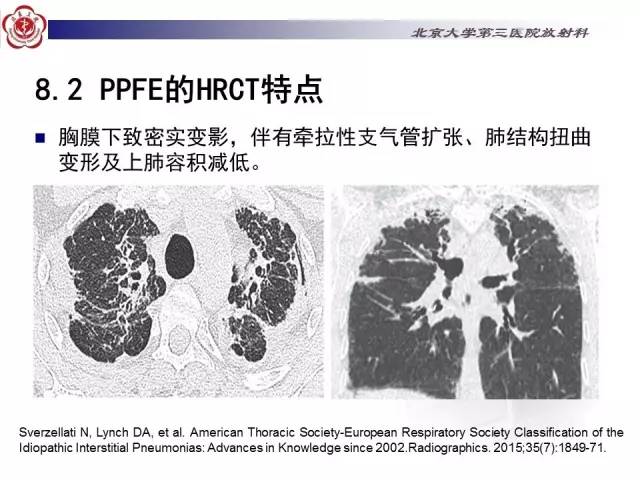 【病例】特发性间质性肺炎2例CT影像表现