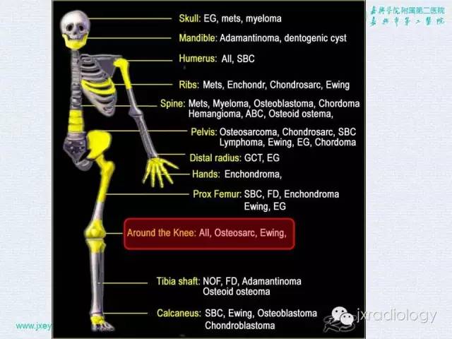 【PPT】膝关节骨肿瘤及肿瘤样病变的MR诊断