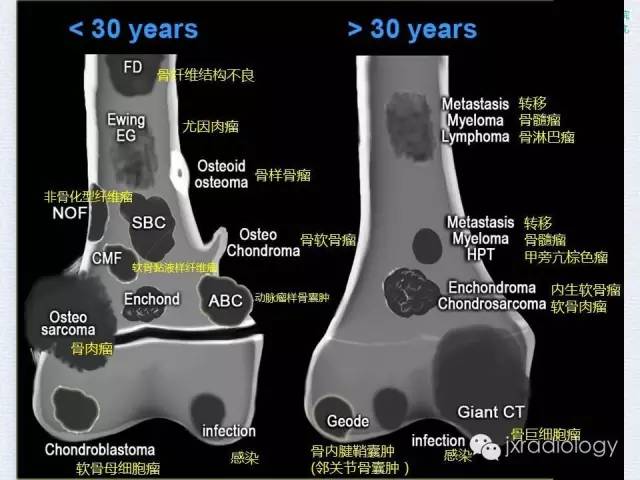 【PPT】膝关节骨肿瘤及肿瘤样病变的MR诊断