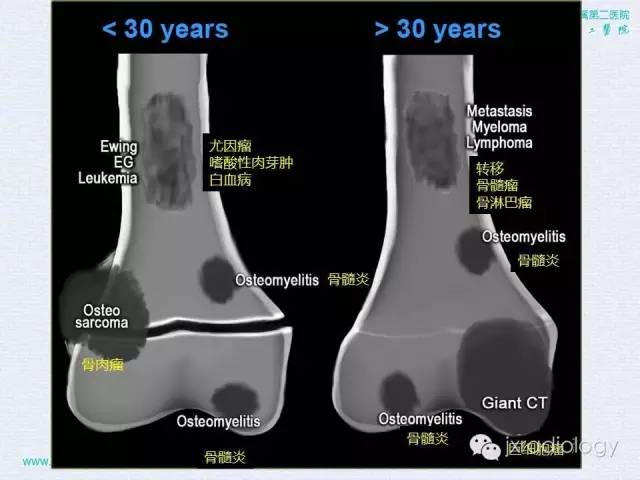 【PPT】膝关节骨肿瘤及肿瘤样病变的MR诊断