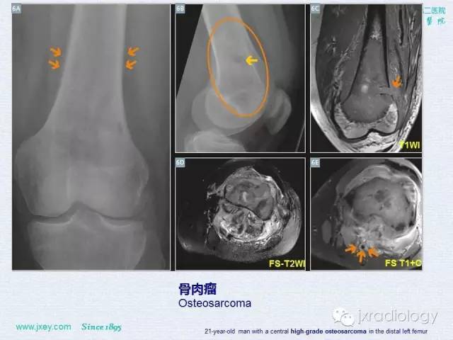 【PPT】膝关节骨肿瘤及肿瘤样病变的MR诊断