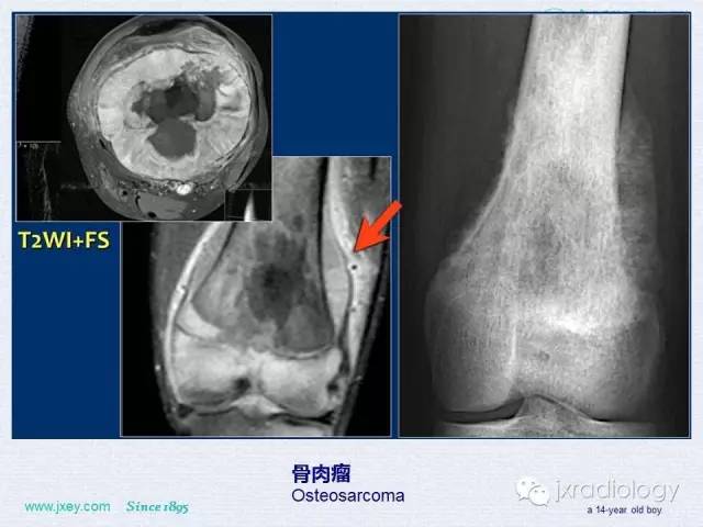 【PPT】膝关节骨肿瘤及肿瘤样病变的MR诊断