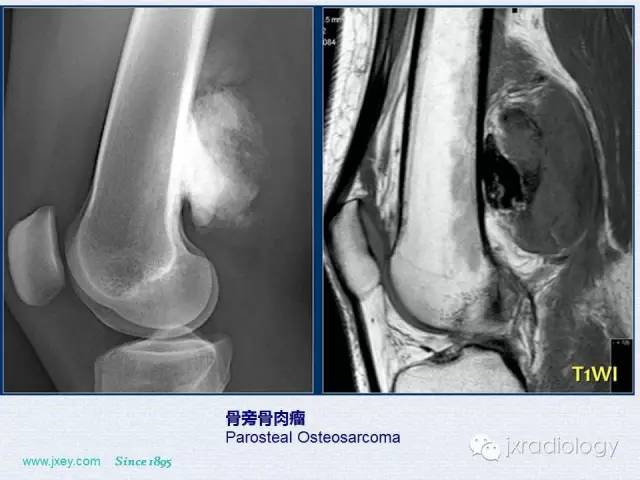 【PPT】膝关节骨肿瘤及肿瘤样病变的MR诊断