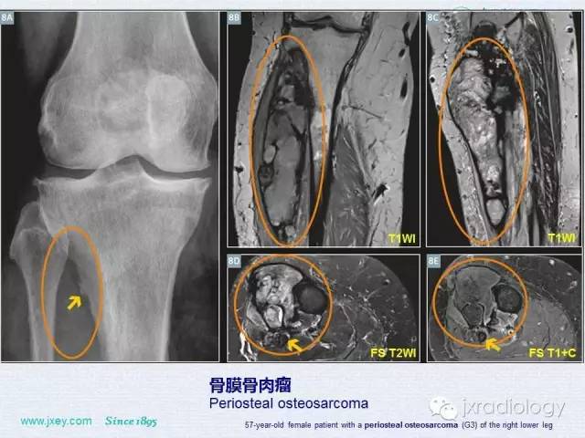【PPT】膝关节骨肿瘤及肿瘤样病变的MR诊断