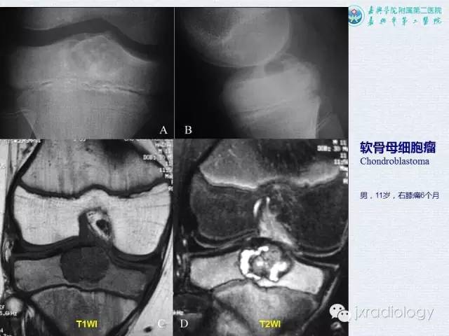 【PPT】膝关节骨肿瘤及肿瘤样病变的MR诊断