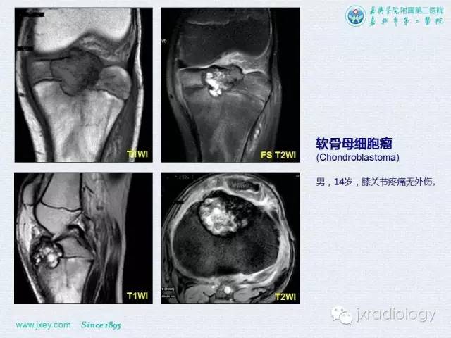 【PPT】膝关节骨肿瘤及肿瘤样病变的MR诊断