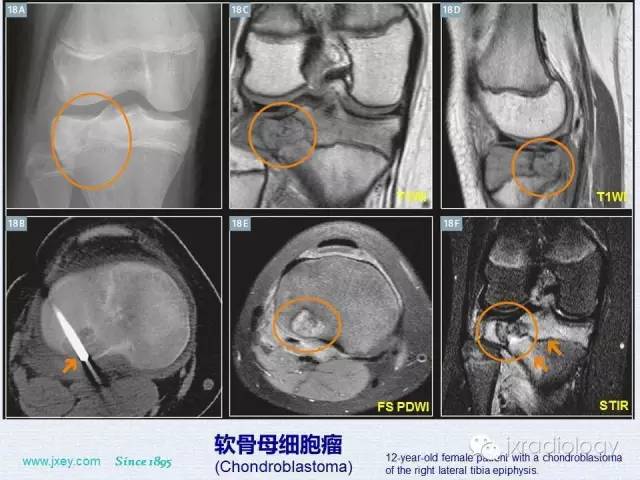 【PPT】膝关节骨肿瘤及肿瘤样病变的MR诊断