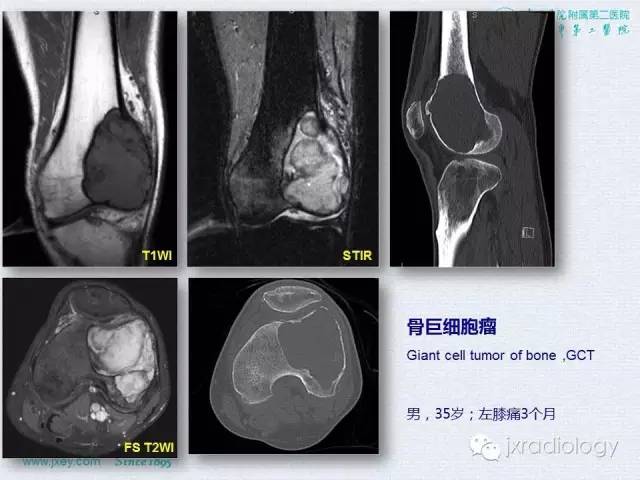 【PPT】膝关节骨肿瘤及肿瘤样病变的MR诊断