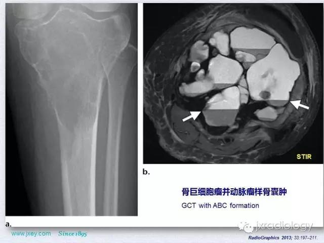 【PPT】膝关节骨肿瘤及肿瘤样病变的MR诊断