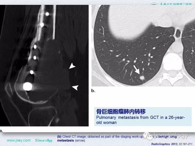 【PPT】膝关节骨肿瘤及肿瘤样病变的MR诊断