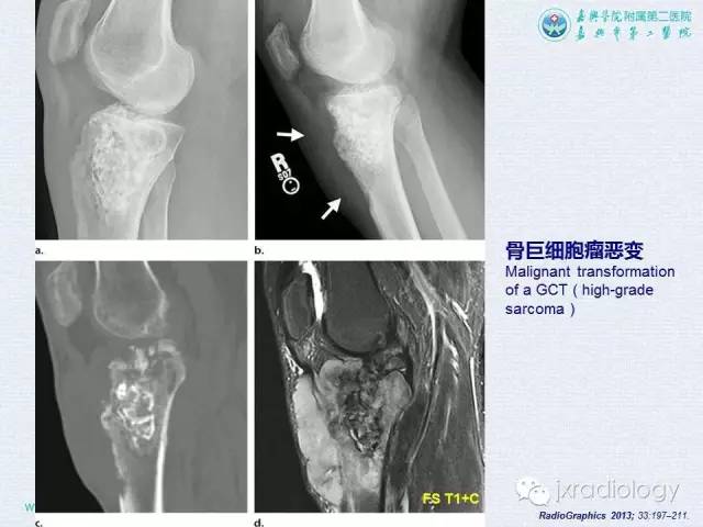 【PPT】膝关节骨肿瘤及肿瘤样病变的MR诊断