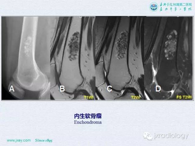 【PPT】膝关节骨肿瘤及肿瘤样病变的MR诊断