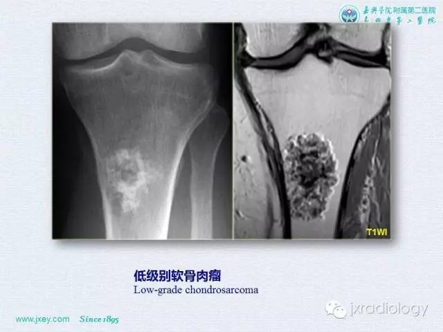 【PPT】膝关节骨肿瘤及肿瘤样病变的MR诊断