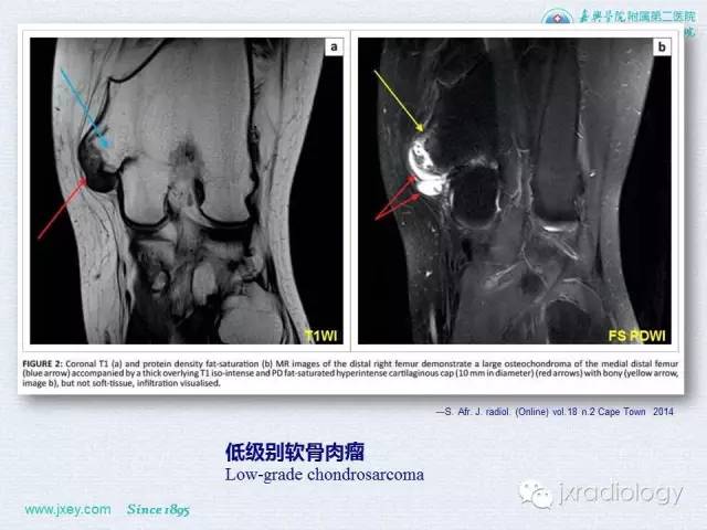 【PPT】膝关节骨肿瘤及肿瘤样病变的MR诊断