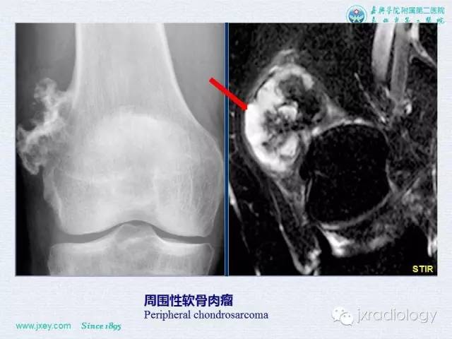 【PPT】膝关节骨肿瘤及肿瘤样病变的MR诊断