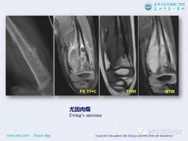 【PPT】膝关节骨肿瘤及肿瘤样病变的MR诊断