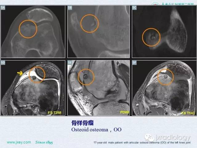 【PPT】膝关节骨肿瘤及肿瘤样病变的MR诊断