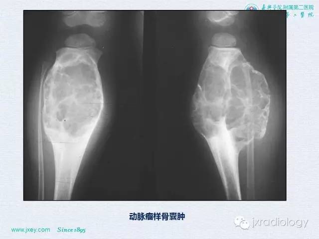 【PPT】膝关节骨肿瘤及肿瘤样病变的MR诊断
