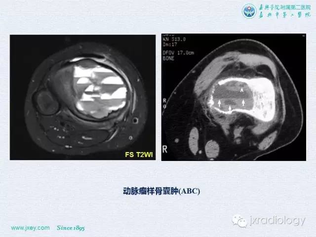 【PPT】膝关节骨肿瘤及肿瘤样病变的MR诊断