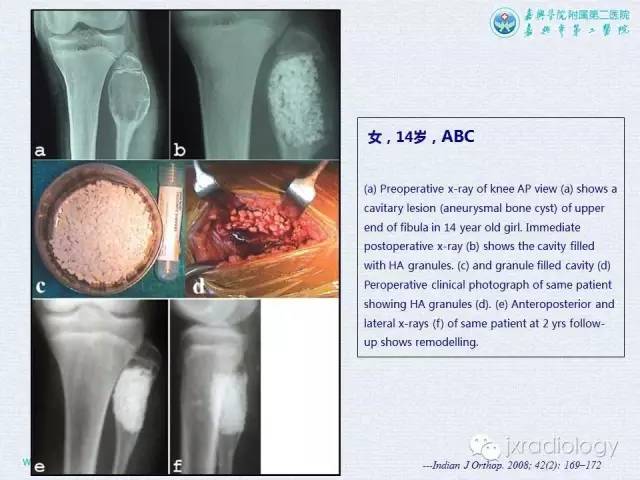 【PPT】膝关节骨肿瘤及肿瘤样病变的MR诊断