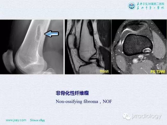 【PPT】膝关节骨肿瘤及肿瘤样病变的MR诊断