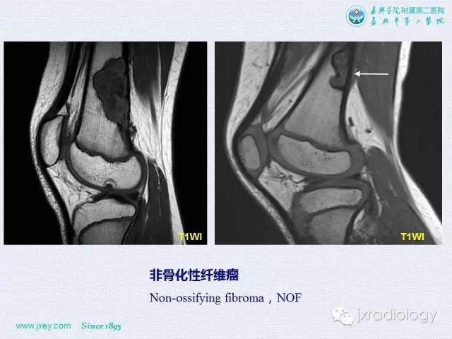 【PPT】膝关节骨肿瘤及肿瘤样病变的MR诊断