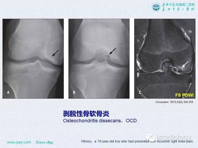 【PPT】膝关节骨肿瘤及肿瘤样病变的MR诊断