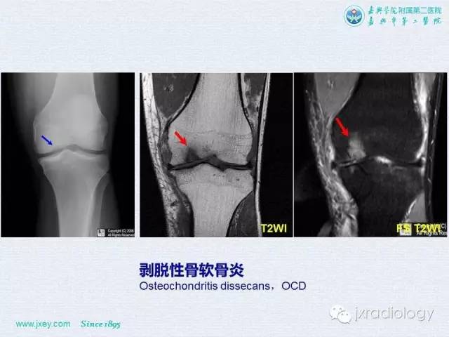 【PPT】膝关节骨肿瘤及肿瘤样病变的MR诊断