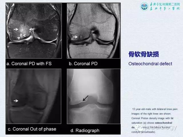 【PPT】膝关节骨肿瘤及肿瘤样病变的MR诊断