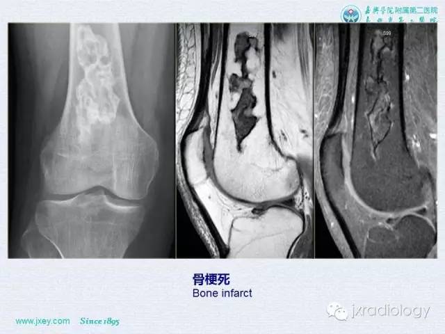 【PPT】膝关节骨肿瘤及肿瘤样病变的MR诊断
