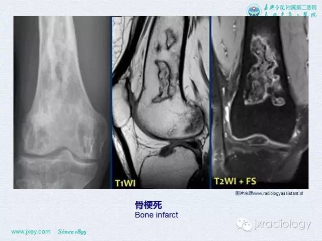 【PPT】膝关节骨肿瘤及肿瘤样病变的MR诊断