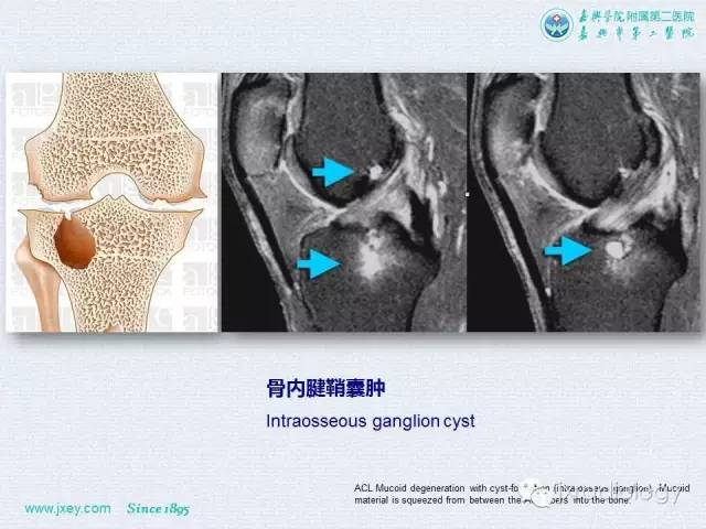 【PPT】膝关节骨肿瘤及肿瘤样病变的MR诊断