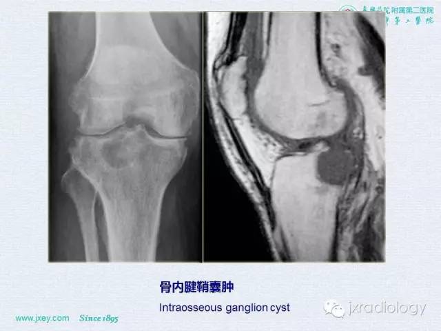 【PPT】膝关节骨肿瘤及肿瘤样病变的MR诊断