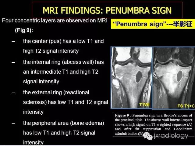 【PPT】膝关节骨肿瘤及肿瘤样病变的MR诊断