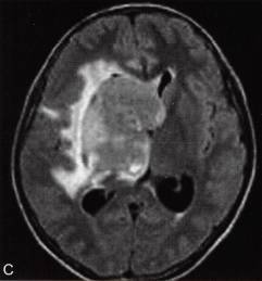 【病例】基底节区异位生殖细胞瘤 1例MR影像表现分析 【病例】基底节区异位生殖细胞瘤 1例MR影像表现分析