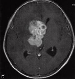 【病例】基底节区异位生殖细胞瘤 1例MR影像表现分析 【病例】基底节区异位生殖细胞瘤 1例MR影像表现分析
