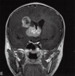 【病例】基底节区异位生殖细胞瘤 1例MR影像表现分析 【病例】基底节区异位生殖细胞瘤 1例MR影像表现分析