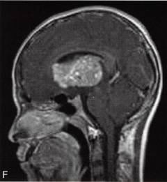 【病例】基底节区异位生殖细胞瘤 1例MR影像表现分析 【病例】基底节区异位生殖细胞瘤 1例MR影像表现分析