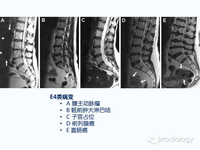 【PPT】腰椎CT、MRI检查的脊柱外异常发现：图文综述