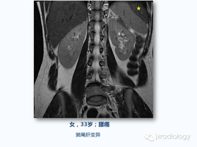 【PPT】腰椎CT、MRI检查的脊柱外异常发现：图文综述