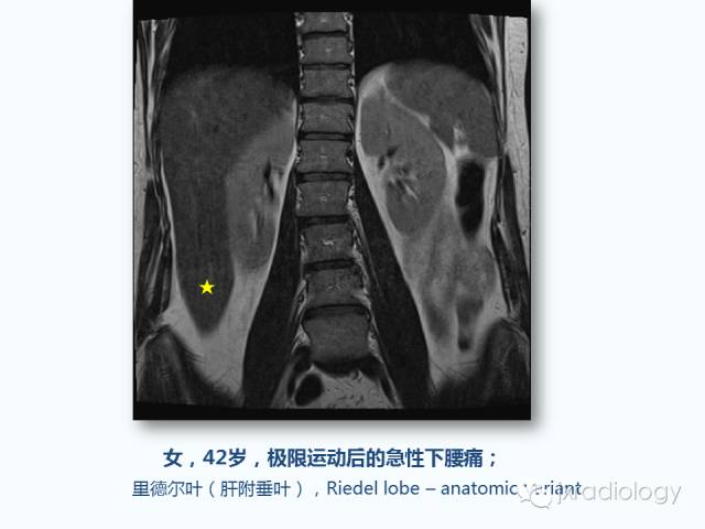 【PPT】腰椎CT、MRI检查的脊柱外异常发现：图文综述