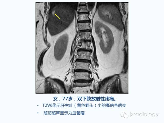 【PPT】腰椎CT、MRI检查的脊柱外异常发现：图文综述
